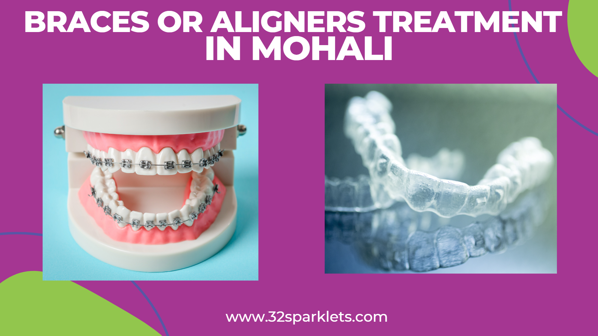 braces and aligners in Mohali, aligner treatment, braces treatment