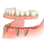 implant supported denture