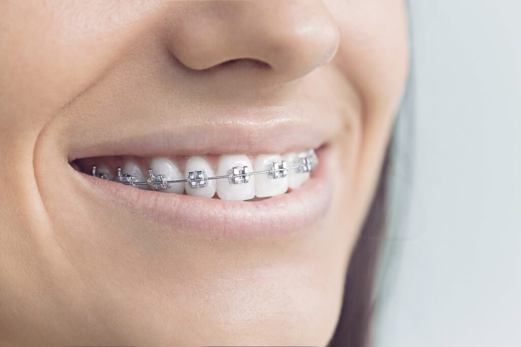 metal braces