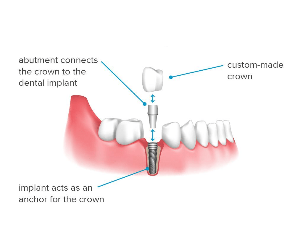 what is a dental implant, dental implant parts, dental implants in Mohali? 