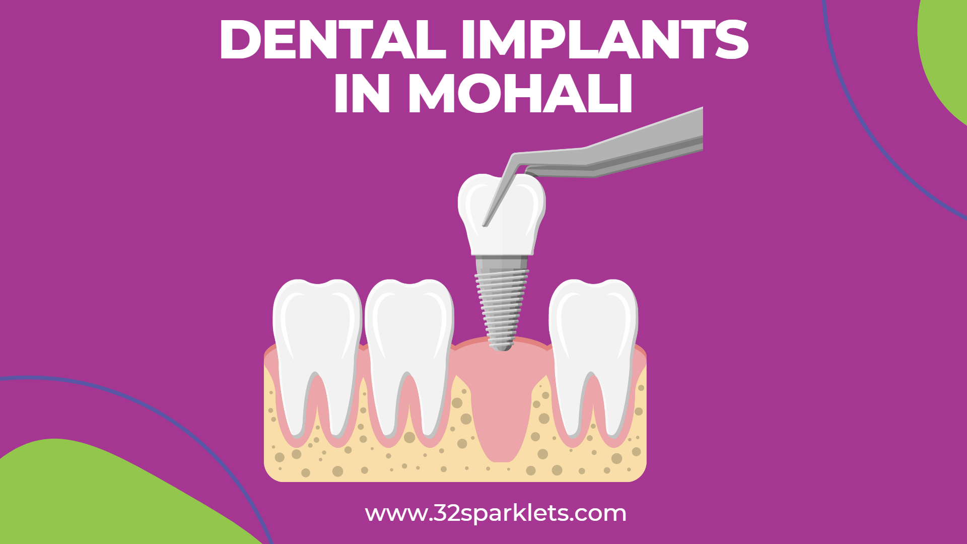 dental implant price in Mohali, dental implant in Mohali, best dentist in Mohali, dental clinic in Mohali