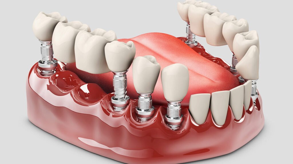 dental implant in Mohali, dental implant with crown, dental implant bridge.