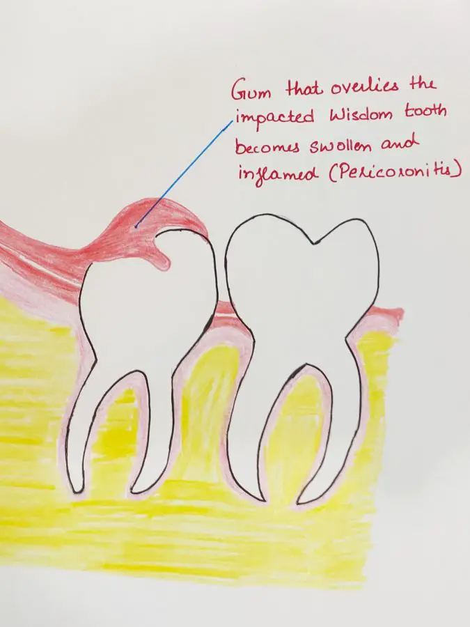 pericoronitis, wisdom tooth, gums, inflammation of the gums