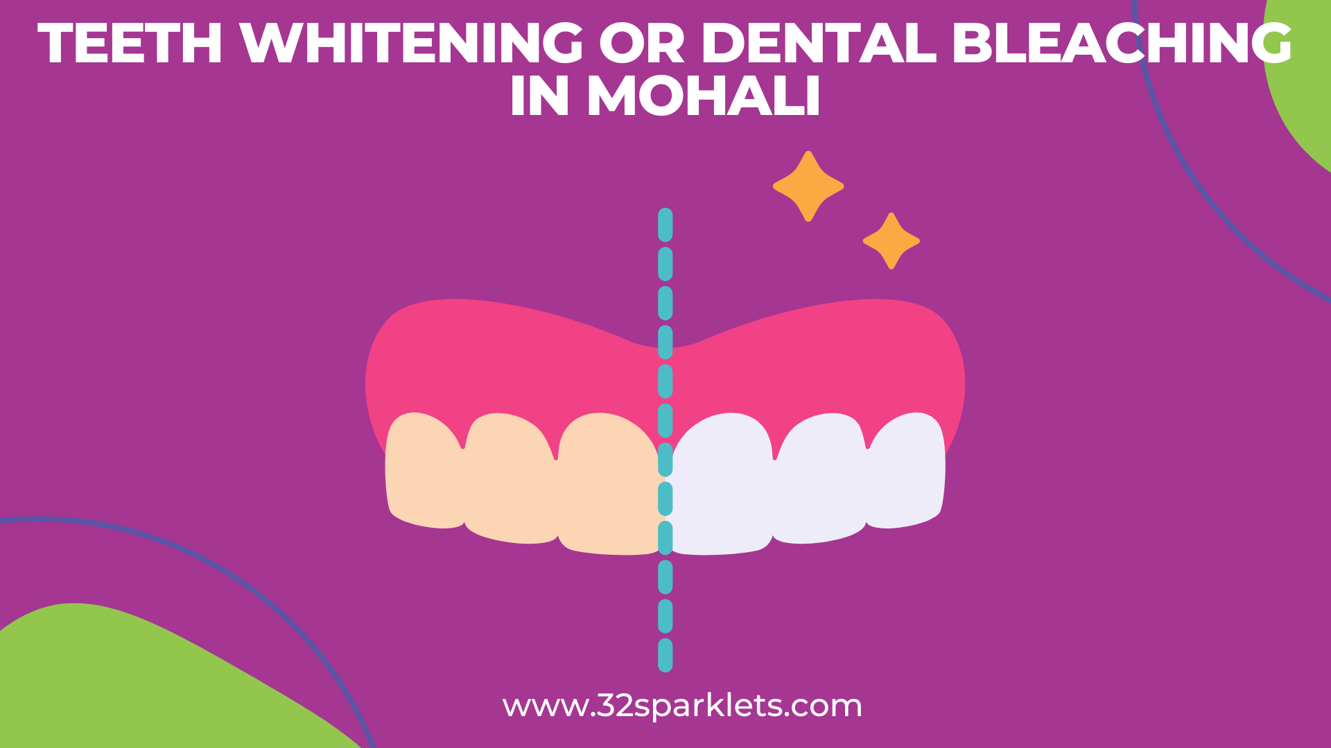 dental bleaching or teeth whitening in Mohali, cost of dental bleaching, bleaching price
