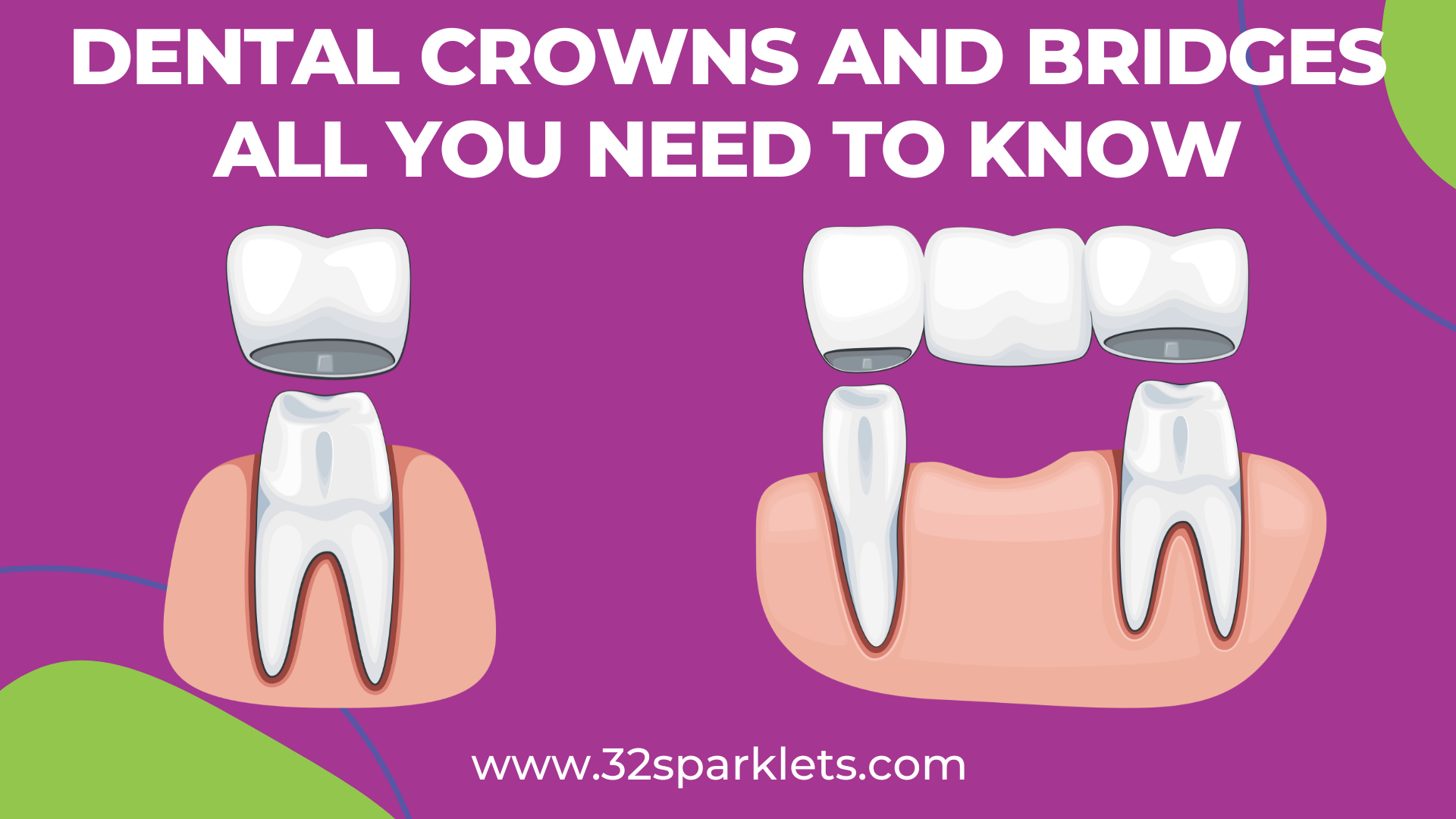 dental crown, dental bridge, tooth crown,