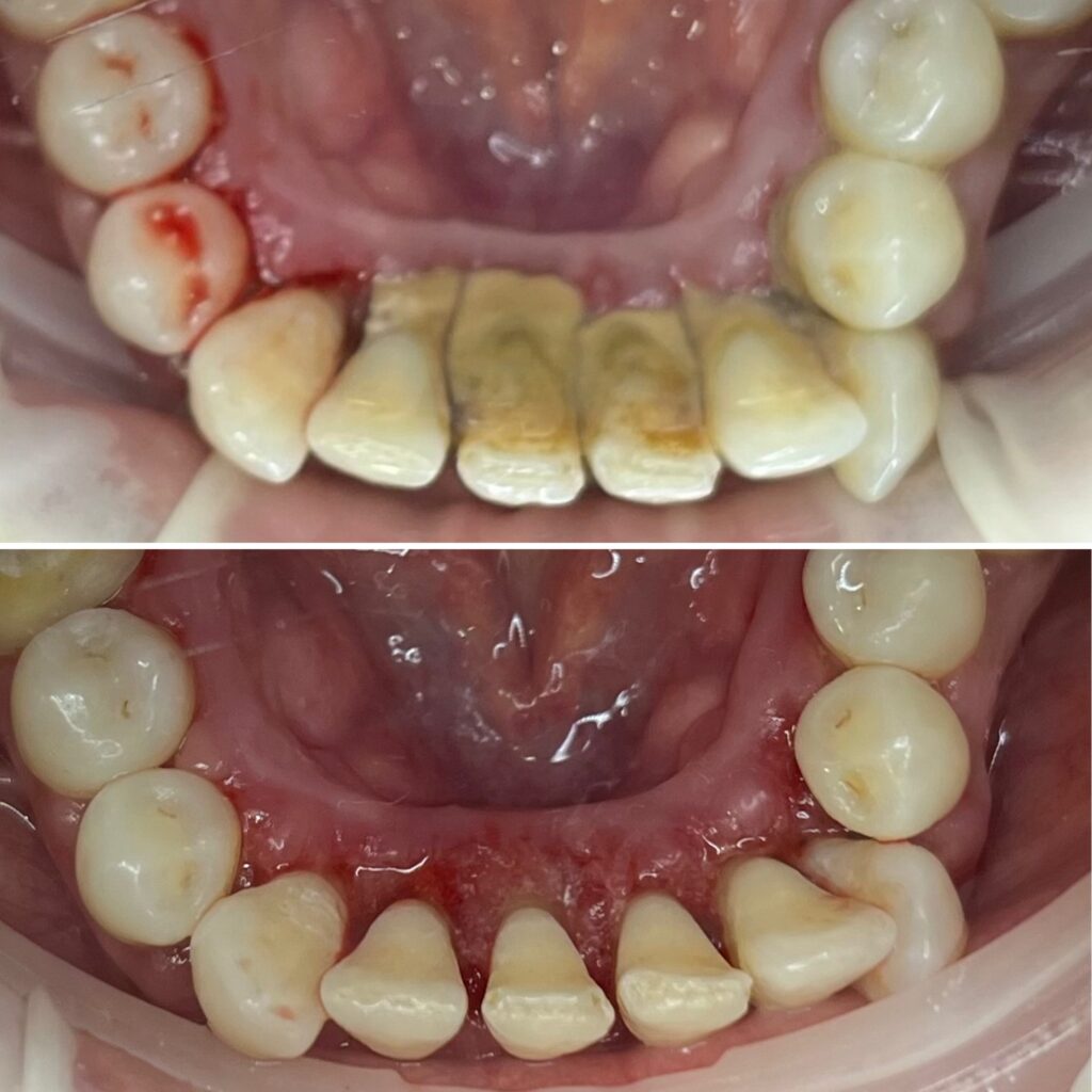 DENTAL CALCULUS REMOVAL FOR TEETH CLEANING