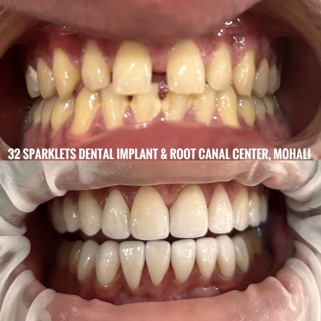 DENTAL VENEERS FOR SPACE CLOSING IN TEETH