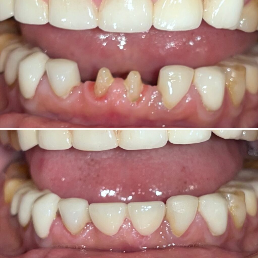 LOWER CENTRAL INCISOR CROWNS