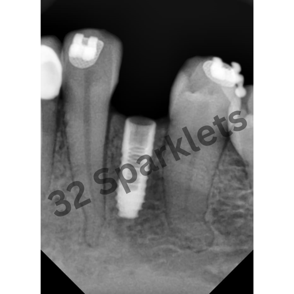 Dental Implants, 32 Sparklets