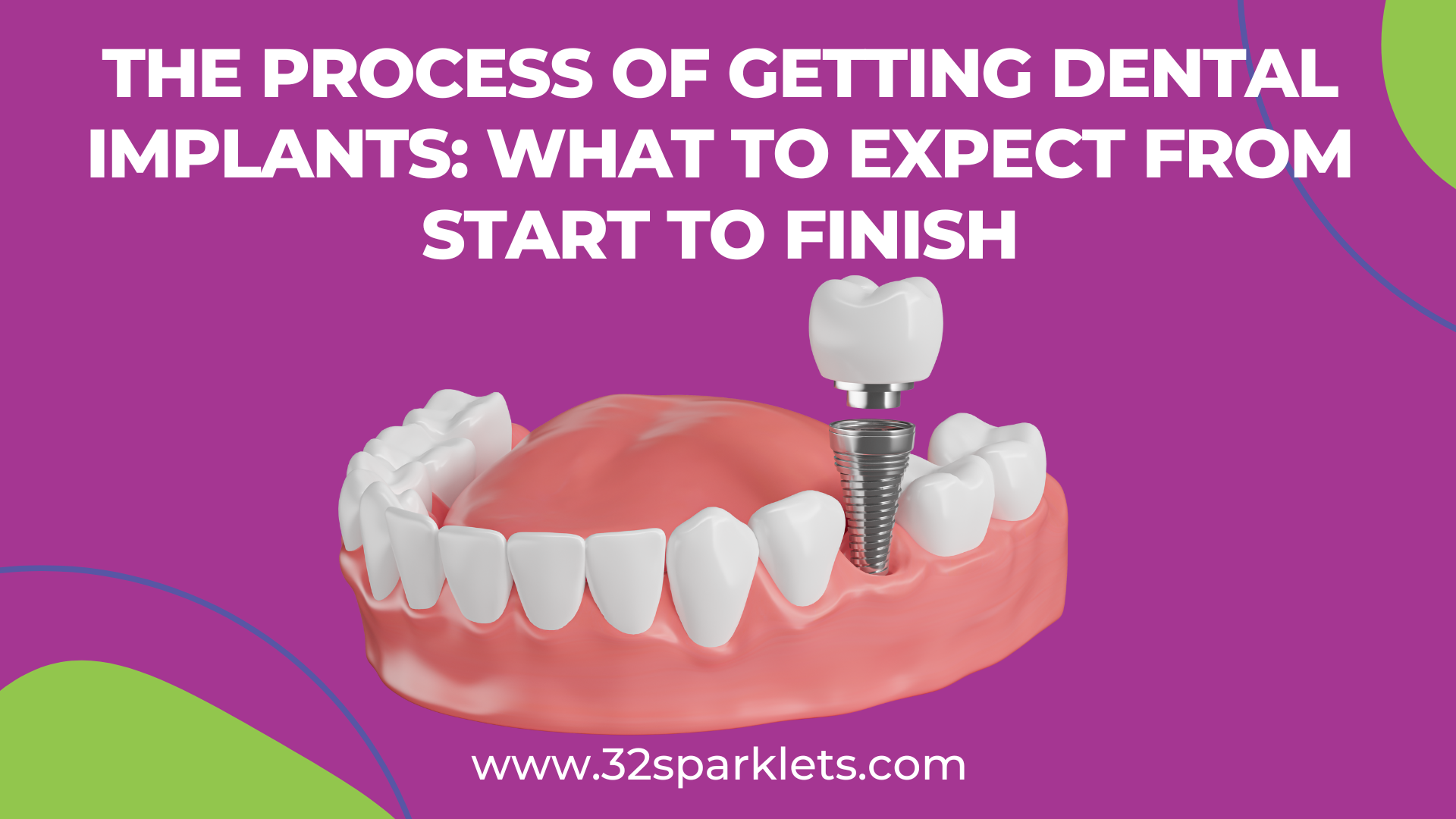 Process of Getting Dental Implants, dental implants